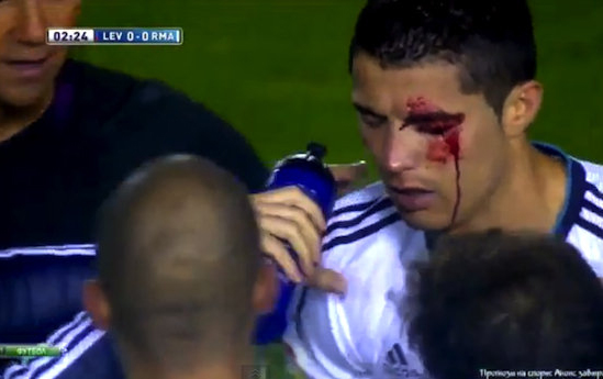 Mặt đầm đìa máu, Ronaldo vẫn ghi bàn 1