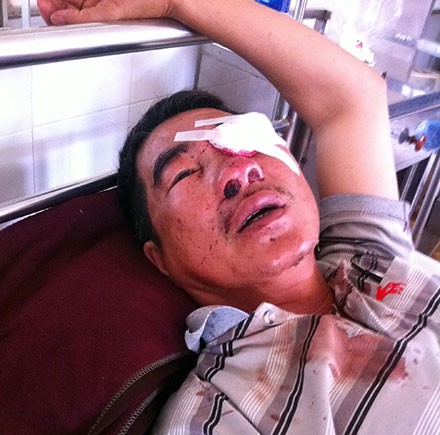 Ông Trương Triệu Lương bị ném đá gây hư mắt trái đang điều trị tại Bệnh viên Đa khoa tỉnh Đắk Lắk. 