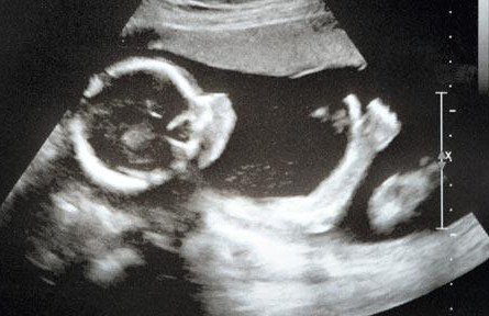 Chỉ với một thao tác nhỏ, bạn có thể xem được thai nhi trong bụng mẹ bằng siêu âm. Hãy cùng xem các hình ảnh về siêu âm thai nhi trong bụng mẹ để hiểu rõ hơn về quá trình sinh trưởng phát triển của thai nhi nhé!