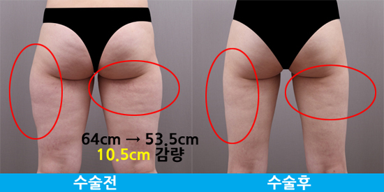 Bị ruồng bỏ, cô gái Hàn giảm 30kg và thẩm mỹ trở nên xinh đẹp 4