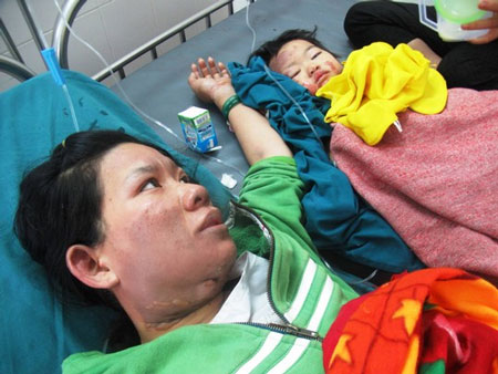 Bồng con nấu ăn, 2 mẹ con bị bỏng nặng 2