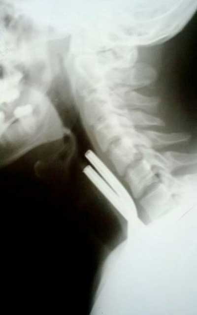 Hy hữu chuyện l&ograve; xo kim loại d&agrave;i 5cm mắc kẹt ở cổ họng 2