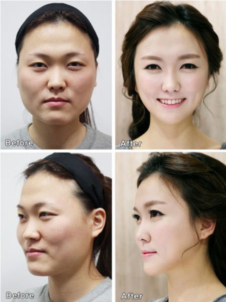Loạt ảnh những gương mặt hoàn hảo sau phẫu thuật thẩm mỹ  28