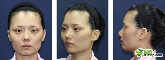 Hành trình phẫu thuật thẩm mỹ "vịt hóa thiên nga" của cô gái Hàn Quốc 1