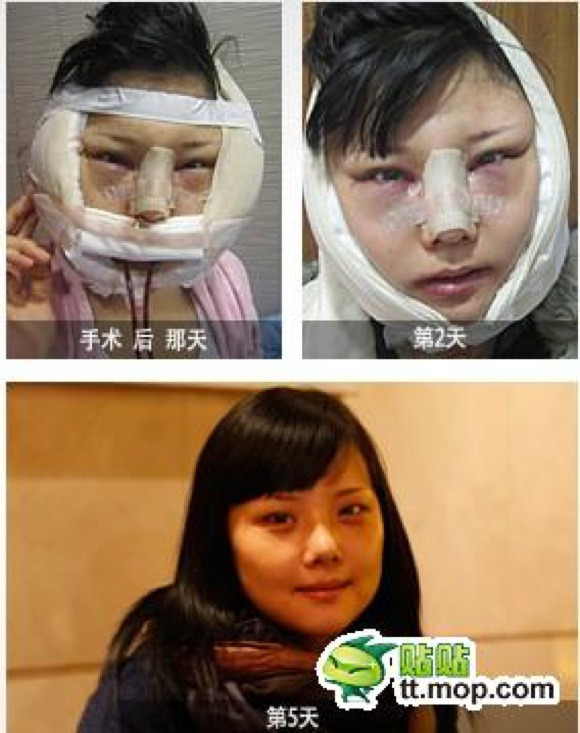 Hành trình phẫu thuật thẩm mỹ "vịt hóa thiên nga" của cô gái Hàn Quốc 3