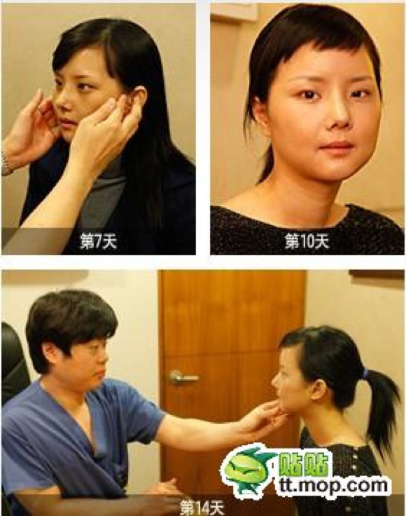 Hành trình phẫu thuật thẩm mỹ "vịt hóa thiên nga" của cô gái Hàn Quốc 4