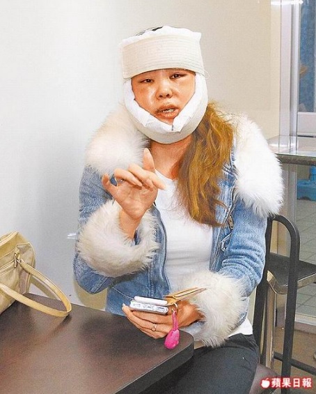 Nữ diễn vi&ecirc;n Đ&agrave;i Loan xấu hổ v&igrave; biến dạng mặt sau thẩm mỹ 1