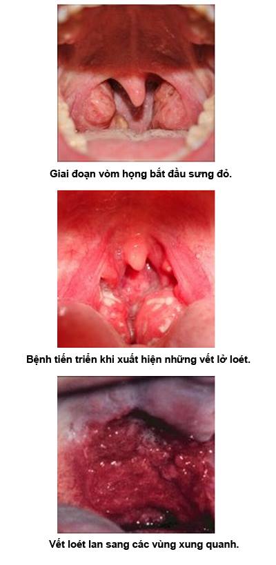 Xem nhanh điều cần biết để phòng tránh bệnh ung thư vòm họng 1