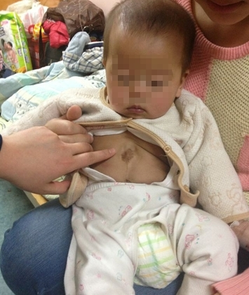 Bé trai 6 tháng tuổi có tim “chạy” khỏi lồng ngực 1
