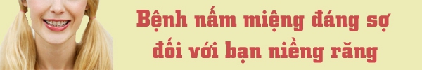 Cẩm nang "đặc biệt" quan trọng khi niềng răng 5