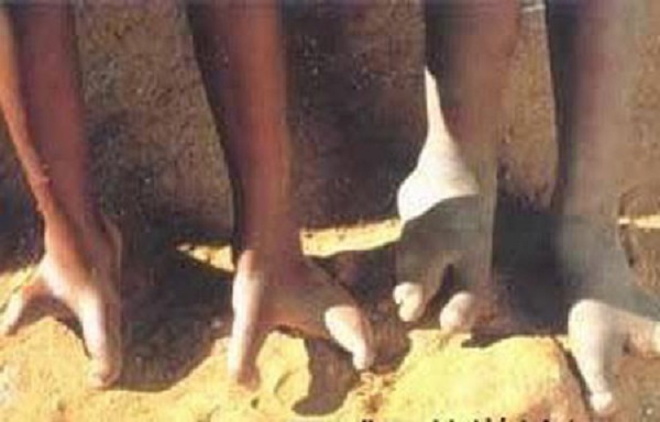 Giải mã bàn chân 2 ngón ở bộ tộc “tôm hùm”  4