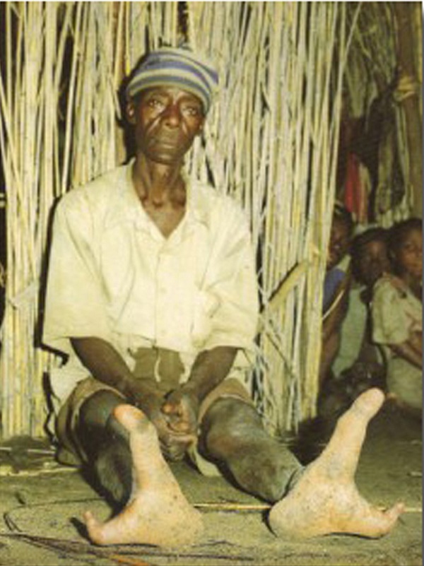 Giải mã bàn chân 2 ngón ở bộ tộc “tôm hùm”  5