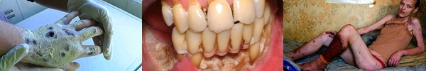 Cận cảnh sự t&agrave;n ph&aacute; của ung thư v&uacute; tới bầu ngực 20