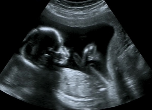 Giả thuyết mới giúp dự đoán giới tính thai nhi qua... hộp sọ 1