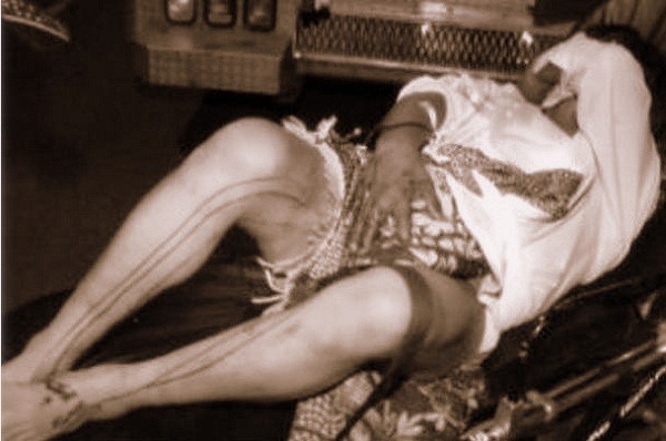 Những chứng bệnh "cuồng loạn" qu&aacute;i gở trong lịch sử 9