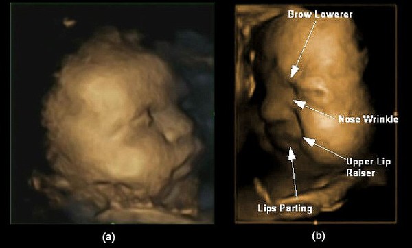Bất ngờ với hình siêu âm em bé... nhăn mặt trong bụng mẹ 3