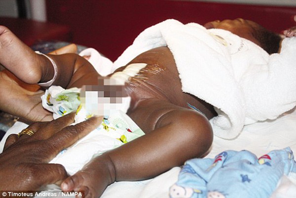 Namibia: Em bé có 4 chân đáng thương 1