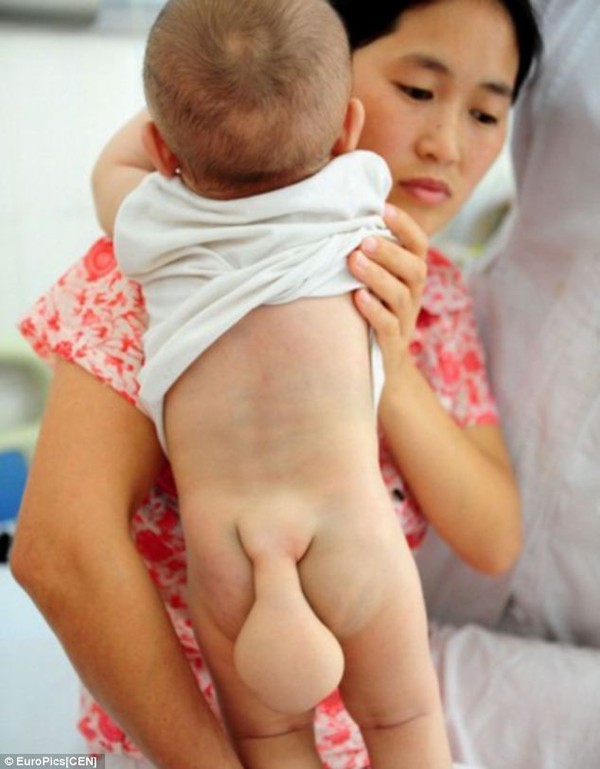 Trung Quốc: Em bé mọc đuôi 10cm sau mông 1