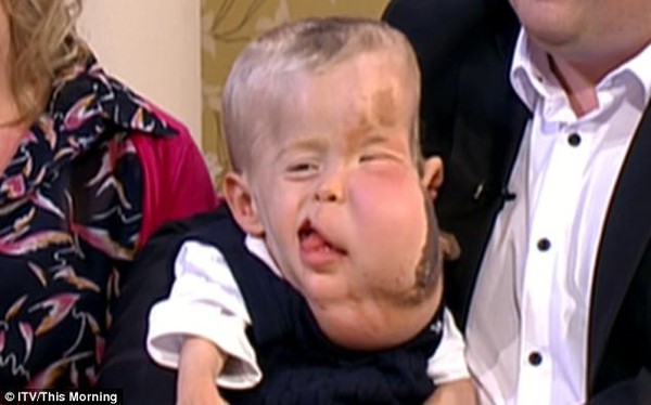 Bệnh lạ không tên khiến khuôn mặt cậu bé 3 tuổi bị biến dạng 1