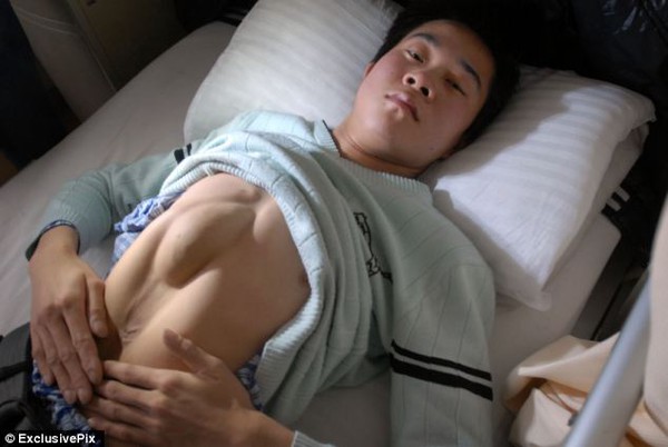 Ch&agrave;ng trai c&oacute; tr&aacute;i tim nh&ocirc; ra khỏi bụng 2