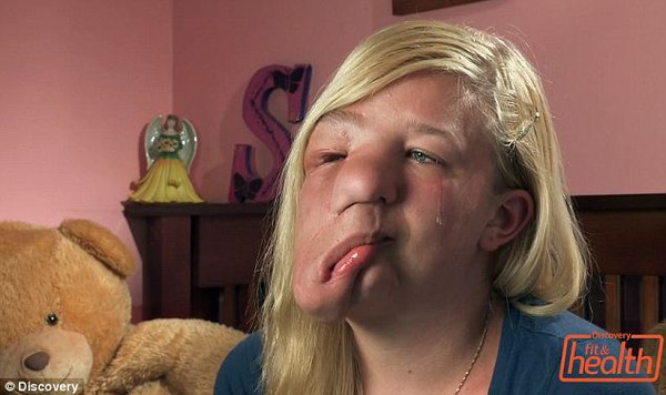 Cô gái trẻ có khuôn mặt "chảy" vì khối u lớn 1