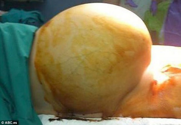 Người phụ nữ mang khối u khổng lồ nặng 25kg trong bụng 1