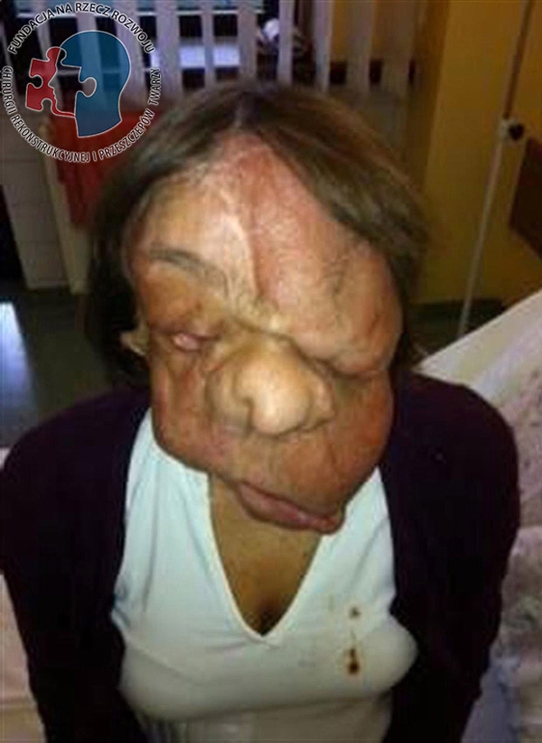 Cô gái có khuôn mặt biến dạng lột xác sau phẫu thuật 1