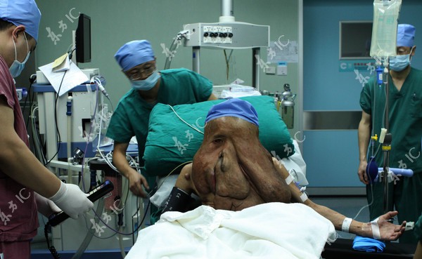 Người voi sở hữu khối u hàng chục kilogram phủ kín mặt 2