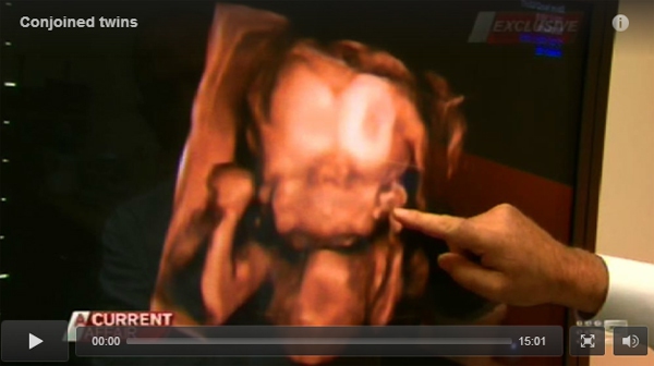 Em bé có 2 khuôn mặt, 2 não bộ cùng phát triển từ 1 hộp sọ 1