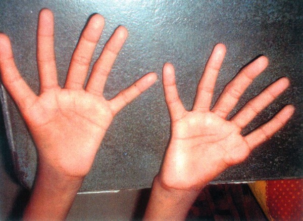 Hại não với đôi bàn tay 5 ngón đều chằn chặn như nhau 2
