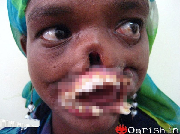 Cô bé châu Phi có hàm răng mọc chờm ra ngoài do mắc bệnh lạ 1