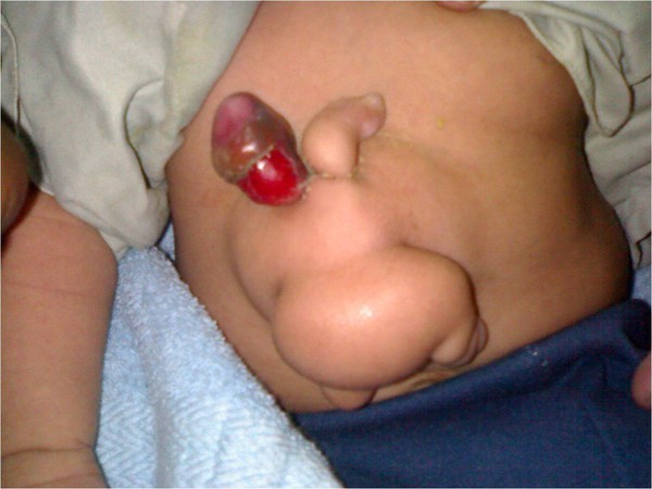 Bào thai sống ký sinh trong cơ thể bé trai 1