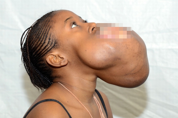 Lạ nhất tuần qua: Cô gái mang khối u lớn bằng quả bóng trong miệng 2