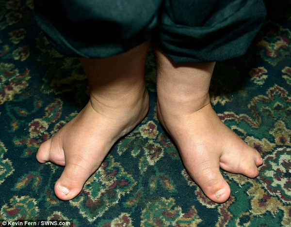 Cậu bé 4 tuổi có đôi bàn chân càng cua 2