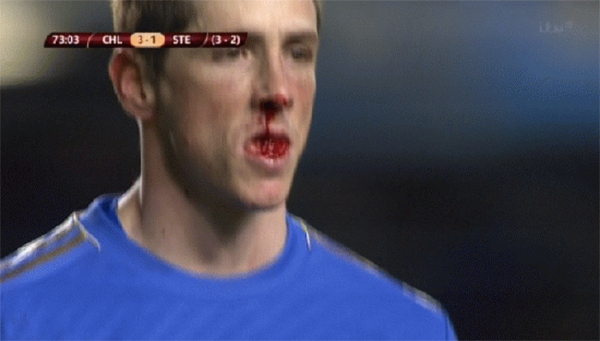 Torres ghi bàn, đổ máu mũi và sút trượt penalty 2