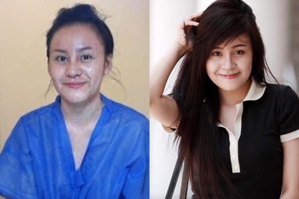 Gương mặt hot girl Việt “sưng phù” sau nghi án dao kéo 10