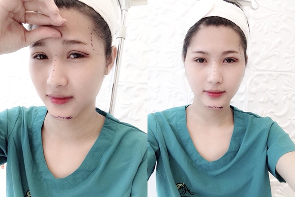 Những cô gái Việt lột xác thần kỳ nhờ phẫu thuật thẩm mỹ 20