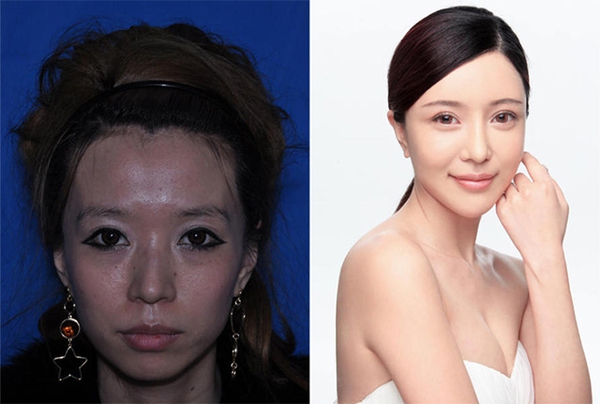 Loạt ảnh các cô gái Trung Quốc trước và sau phẫu thuật thẩm mỹ gây choáng 2