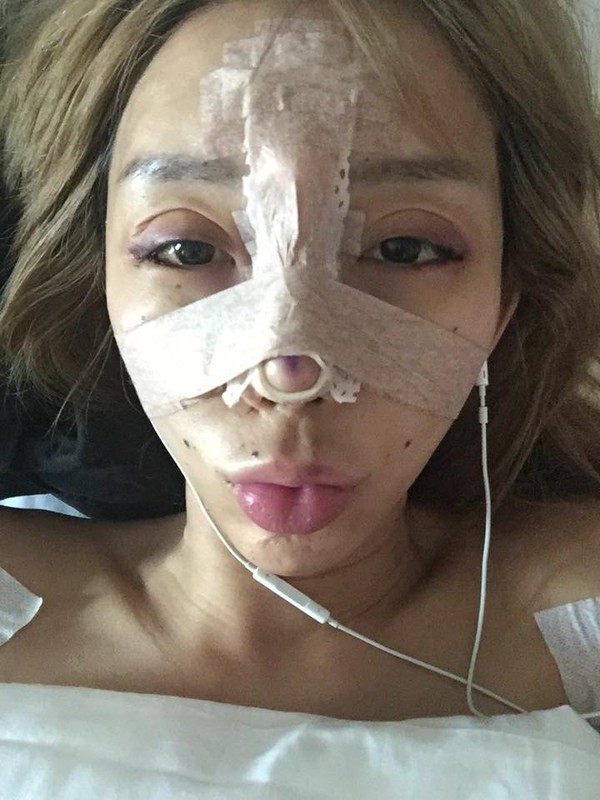 Nữ DJ nổi tiếng Malaysia c&ocirc;ng khai loạt ảnh phẫu thuật thẩm mỹ g&acirc;y sốc 3