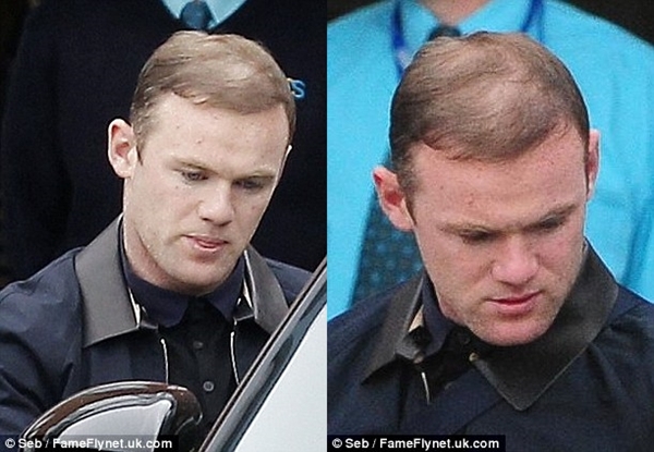 Rooney lại chi tiền tấn để chữa hói 1