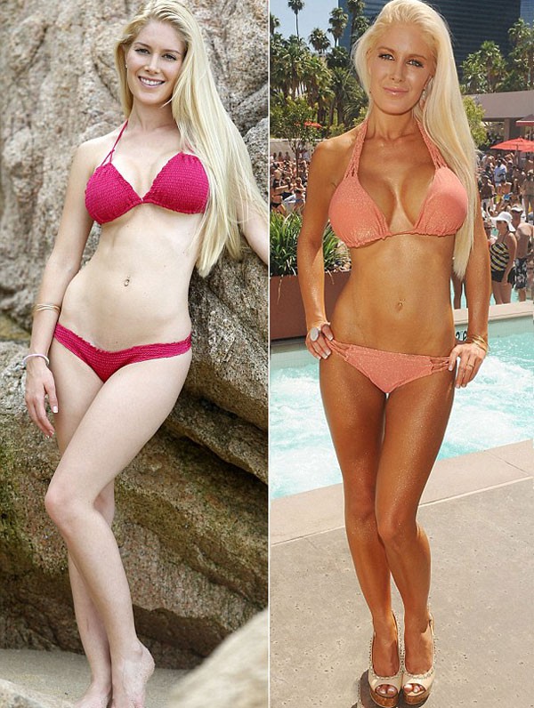 Heidi Montag đau đớn vì bơm ngực quá to 2