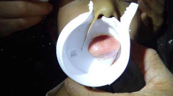 Đang u&ocirc;́ng nước, lưỡi bị mắc kẹt m&ocirc;̣t cách khó hi&ecirc;̉u vào nắp c&ocirc;́c nhựa 1