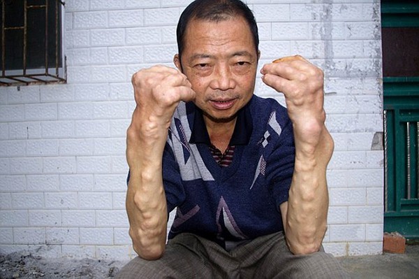 Ng&ocirc;i l&agrave;ng bị mọc u thịt xấu x&iacute; khắp người do ăn phải chất độc cadimi 1