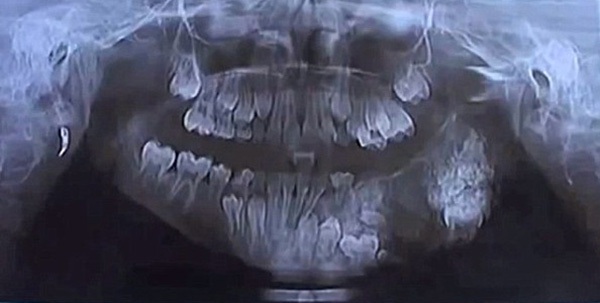 Phát choáng với hàm răng có 80 chiếc răng thừa của cậu bé 7 tuổi 2