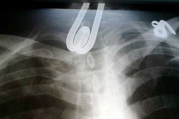 Hy hữu chuyện l&ograve; xo kim loại d&agrave;i 5cm mắc kẹt ở cổ họng 1