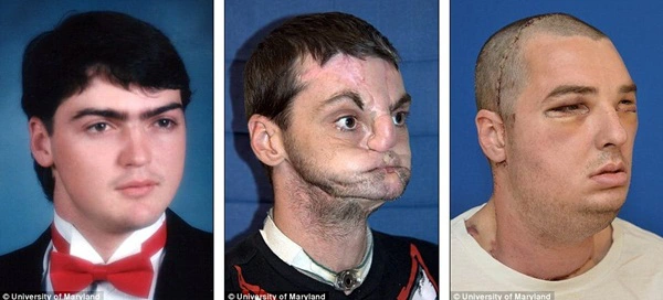 Người đ&agrave;n &ocirc;ng được cấy gh&eacute;p mặt to&agrave;n diện nhất thế giới 1