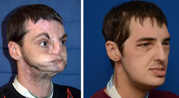 Người đ&agrave;n &ocirc;ng được cấy gh&eacute;p mặt to&agrave;n diện nhất thế giới 2