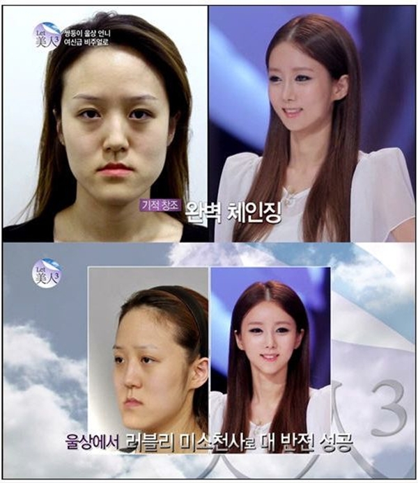 Cô gái xấu xí được phẫu thuật thẩm mỹ thành "bản sao YoonA" của SNSD 1