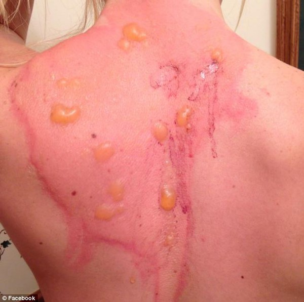 Cô gái trẻ bị bỏng lưng vì thử nghiệm nước sôi đóng băng 3