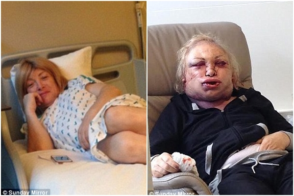 Gương mặt biến dạng, đau đớn sau PTTM của người phụ nữ chuyển giới 1